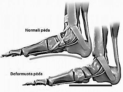 1.3. Plokščiapėdystės samprata, priežastys ir požymiai, nustatymo metodai Plokščiapėdystė tai deformacija, kuri atsiranda nusileidus arba išnykus pėdos skliautams, pakilęs pėdos išorinis kraštas ir