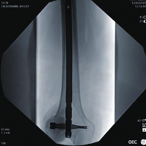 Only true continuous fluoroscopy (without pulsing) captures detailed anatomy without the distraction of the stutter, lag, or ghosting that characterizes continuous pulse