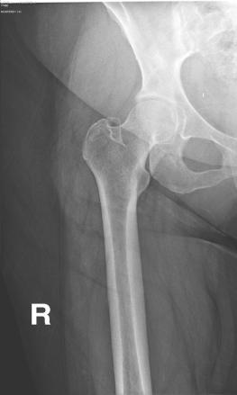 A perfect example of this is centering for a proximal femur using a 14 x 17 on a patient with a large