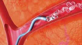 MERIT MAESTRO MICROCATHETERS The Merit Maestro is a multipurpose microcatheter designed for use in peripheral and coronary vasculature.