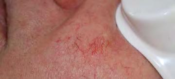 AFTER Hair removal Vascular lesions Benign