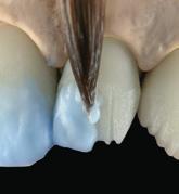 Select a transparent dentine pellet (e.g.: TD-A1). 4.