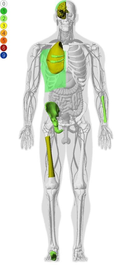 Injur y Data Visual Anatomical Injury Descriptor (VisualAid or VAID) Developed and used by Department of Defense Army Research Laboratory