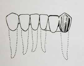 zob nosilcev, odsotnost zatičkov z nazidki na končnih nosilcih, zadostna višina klinične krone skrajnega nosilca, priporočljivo je, da so antagonisti delna ali totalna proteza, v
