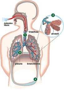 Slika 1: Uinkovanje azbesta v pljuih 3.1.1.Azbestoza Azbestoza je bolezen pljunega intersticija, za katero je znailna fibroza, tj. brazgotinjenje in prisotnost azbestnih telesc.