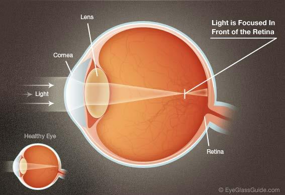 Nearsightedness (myopia): Eye focal length is shorter than normal, too much bending power. Far point is too close. Objects beyond far point appear blurred.