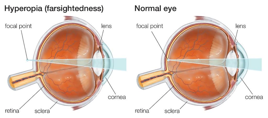 Farsightedness (hyperopia): Image of distant objects falls behind the retina