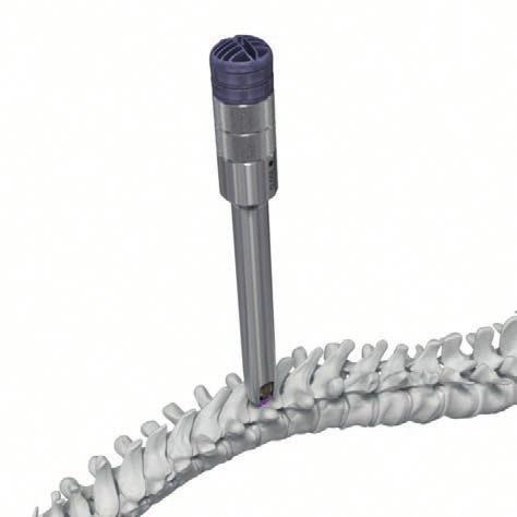 SCREW INSERTION 4 Insert TROLLEY GVs 1 Instruments 03.625.001 TROLLEY Screwdriver The TROLLEY GV can now be inserted into the prepared pedicle under fluoroscopic control.