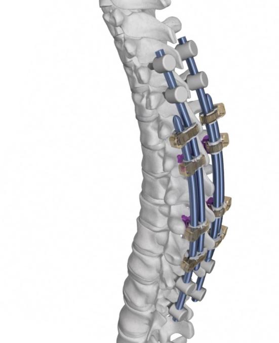 CONCEPT AND INTRODUCTION CONCEPT The TROLLEY passive growth-guiding solution is based on the concept introduced by Eduardo R. Luque (Luque, 1982*) to guide spinal growth along a given trajectory.
