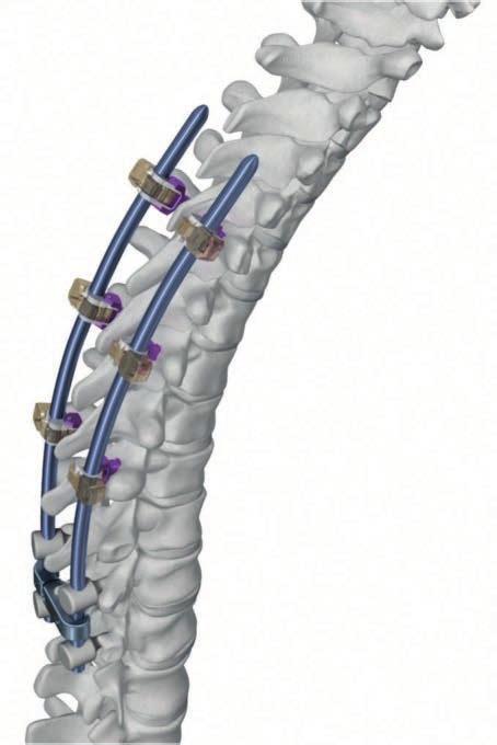 PRECAUTIONS AND WARNINGS PRECAUTIONS The TROLLEY implants and instruments are an addition to the indicated pedicle screw systems below.