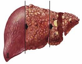 Liver cancer or liver failure: In some cases people living with Hepatitis C can develop liver cancer, or their liver can stop working (liver failure).