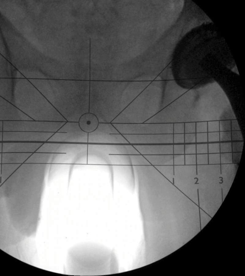 Arthroplasty (THA), there is one aspect of this technology that is greatly misunderstood: image distortion.