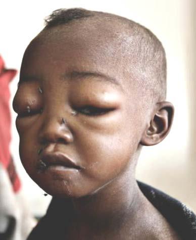 Bilateral Pitting Oedema (Nutritional Oedema) * Oedema is a sign of severe acute malnutrition (SAM)