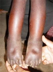 If the skin stays depressed on both feet, the client has Grade + (mild) bilateral pitting oedema. 4.