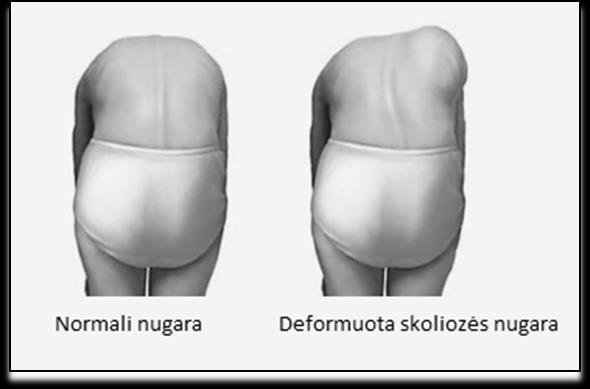 Liemens slanksteliai lenkiami į išgaubtą skoliozės lanko pusę, dešinėn, o krūtinės slanksteliai į įgaubtą pusę, kairėn.