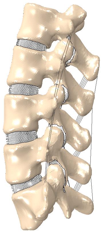 Surrogate Spine Model Disc Defined as Ball in Socket with 6DOF