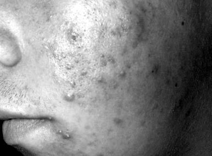 ISIKLIK HÜGIEEN SAGEDASEMAD HAIGUSED TEISED NAHAHAIGUSED Acne vulgaris ehk harilik akne on naha (karvanääpsu) rasunäärmete krooniline põletik, mis tavaliselt algab puberteedieas ning võib kesta 20.