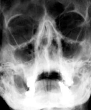 NINALUU MURD (joonis 1) esineb nina deformatsioon, ebanormaalne liikuvus, ninaverejooks, hematoom silmade all ja nina piirkonnas, pehmete kudede turse, nina kaudu hingamine on takistatud.