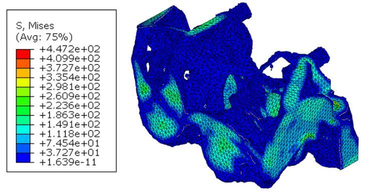 It yielded lower stress levels and deformations compared to the model for milling, as