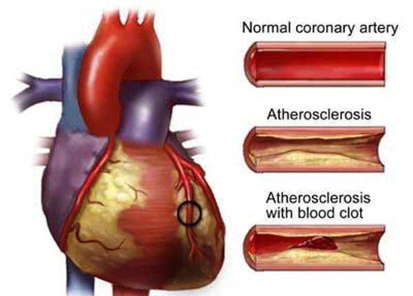 4- Observe the following picture and answer the questions below: Accumulation of fats Formation of a blood clot A B C a. What do we call the heart diseases? b. What are the causes of these diseases?